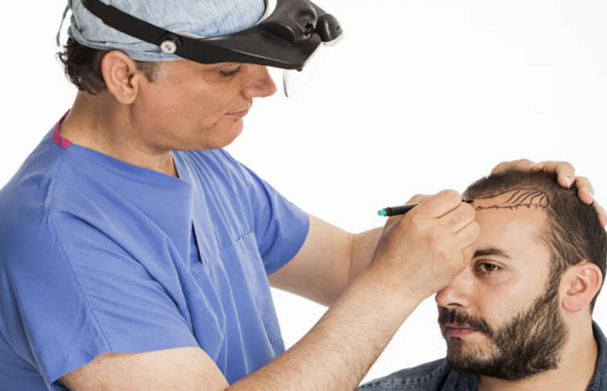 Hair Transplant Abroad: Unlocking Savings and Quality Together
