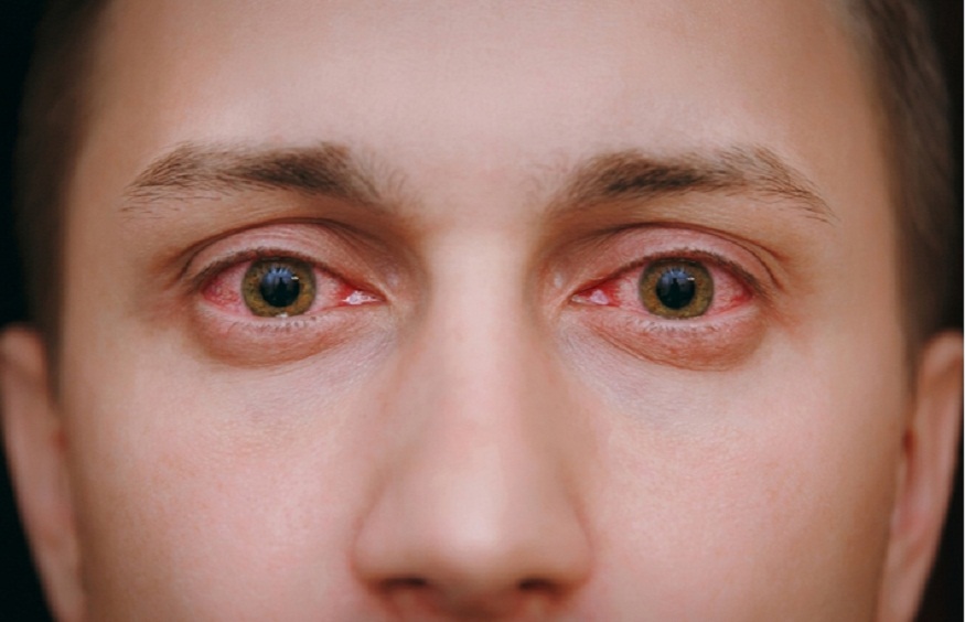 Managing Chronic Eye Infections