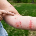 Treatment Of Poison Ivy Rashes