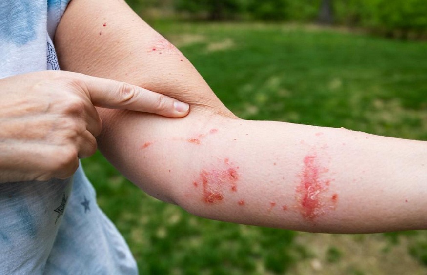 Treatment Of Poison Ivy Rashes