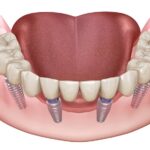 Full Mouth Rehabilitation