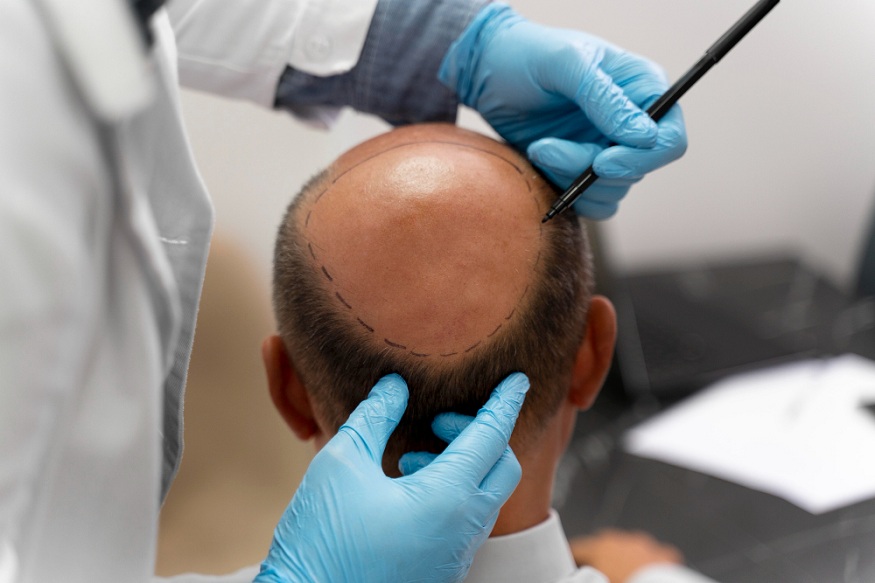 Hair Transplant Procedures