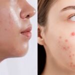 Managing Acne-Prone Skin