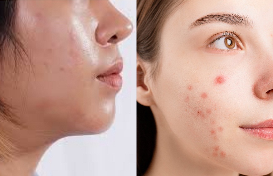 Managing Acne-Prone Skin